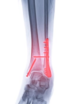  X-ray image of ankle joint showing internal fixation with plate and screw.