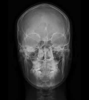 X-ray image of Human Skull   Front  view for diagnosis skull fracture  isolated on Black Background.