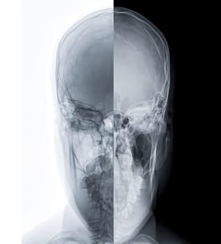 X-ray image of Human Skull  town's view for diagnosis skull fracture  isolated on Black Background.