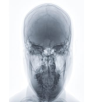 X-ray image of Human Skull  town's view for diagnosis skull fracture  isolated on Black Background.