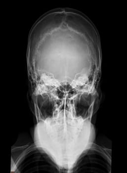 X-ray image of Human Skull  town's view for diagnosis skull fracture  isolated on Black Background.