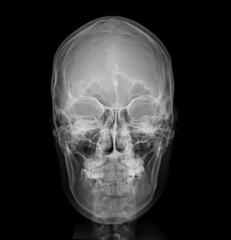 X-ray image of Human Skull   Front  view for diagnosis skull fracture  isolated on Black Background.