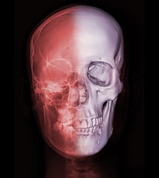 X-ray image of Human Skull   Front  view with 3D rendering for diagnosis skull fracture  isolated on Black Background.