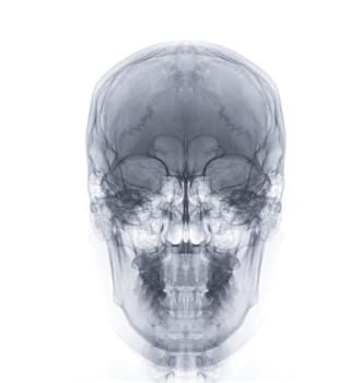 X-ray image of Human Skull   Front  view for diagnosis skull fracture  isolated on Black Background.