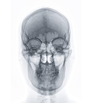 X-ray image of Human Skull   Front  view for diagnosis skull fracture  isolated on Black Background.