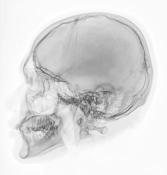  x-ray image of Human Skull   lateral view for diagnosis skull fracture  isolated on Black Background.