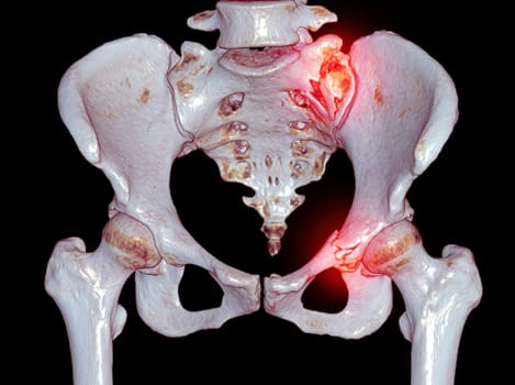 CT Scan pelvic bone with both hip joint 3D rendering  showign fracture of sacrum and superior pubic rumus.