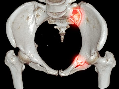 CT Scan pelvic bone with both hip joint 3D rendering  showign fracture of sacrum and superior pubic rumus.