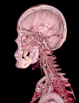  CTA brain and carotid artery or CT angiography of the brain  3D Rendering image .