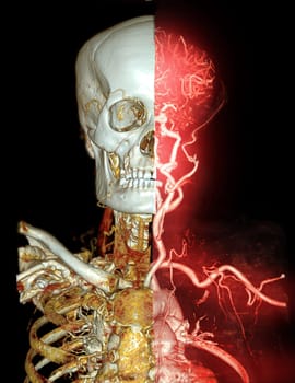  CTA brain and carotid artery or CT angiography of the brain  3D Rendering image .