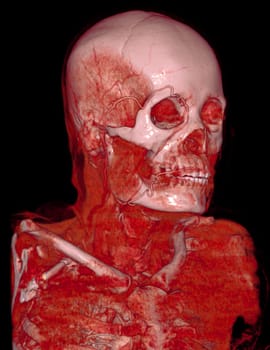  CTA brain and carotid artery or CT angiography of the brain  3D Rendering image .