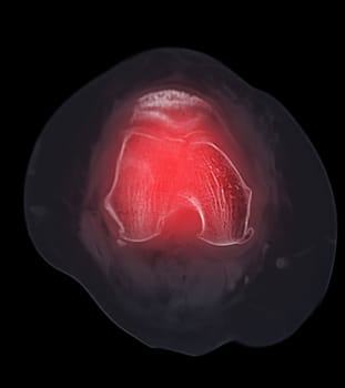 CT scan of knee joint   showing fracture of distal femur bone.