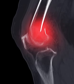 CT scan of knee joint   showing fracture of distal femur bone.