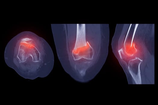 CT scan of knee joint 3D rendering image  showing fracture of distal femur bone.