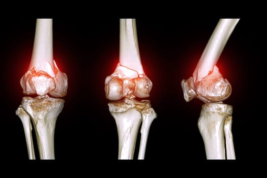 CT scan of knee joint 3D rendering image  showing fracture of distal femur bone.