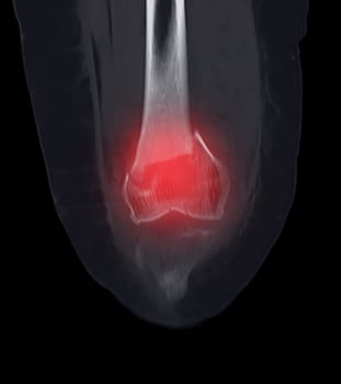 CT scan of knee joint   showing fracture of distal femur bone.
