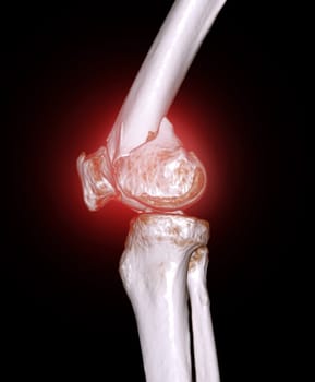 CT scan of knee joint 3D rendering image  showing fracture of distal femur bone.