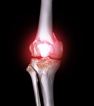 CT scan of knee joint 3D rendering image  showing fracture of distal femur bone.