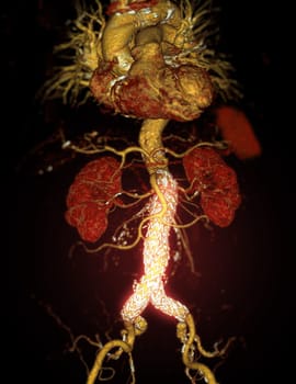 CTA whole aorta with Abdominal aorta stent graft 3D rendering image in case  abdominal aortic aneurysms.