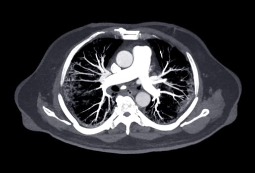 CTA pulmonary arteries 3D rendering showing branch of pulmonary artery