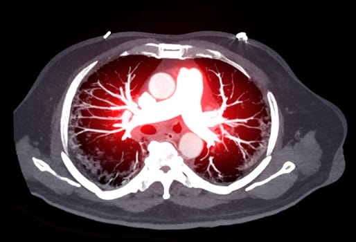 CTA pulmonary arteries 3D rendering showing branch of pulmonary artery