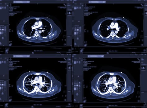 CTA pulmonary arteries 3D rendering showing branch of pulmonary artery