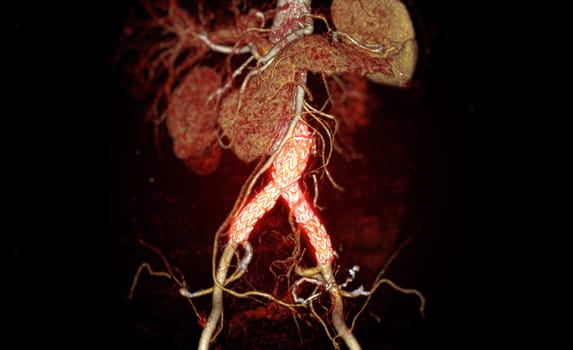 CTA of the aorta with stent-grafting in patient Abdominal aortic aneurysm.