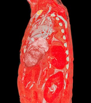 CTA pulmonary arteries 3D rendering showing branch of pulmonary artery