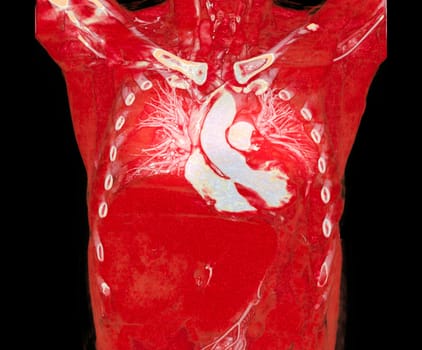 CTA pulmonary arteries 3D rendering showing branch of pulmonary artery