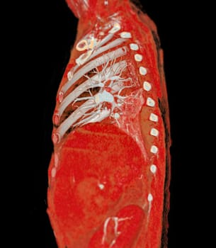 CTA pulmonary arteries 3D rendering showing branch of pulmonary artery