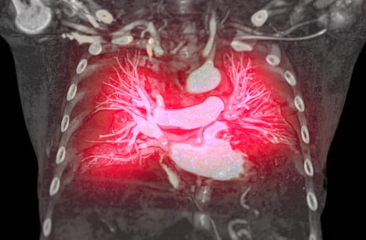 CTA pulmonary arteries 3D rendering showing branch of pulmonary artery