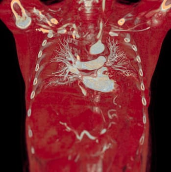 CTA pulmonary arteries 3D rendering showing branch of pulmonary artery