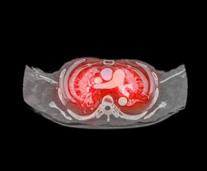 CTA pulmonary arteries 3D rendering showing branch of pulmonary artery