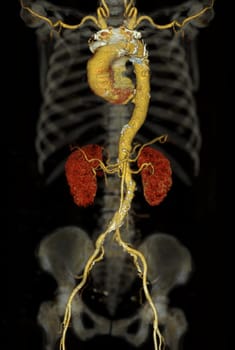 CTA whole aorta 3D rendering.