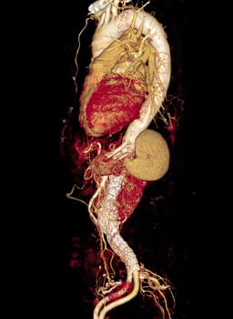 CTA of the aorta with stent-grafting in patient Abdominal aortic aneurysm.