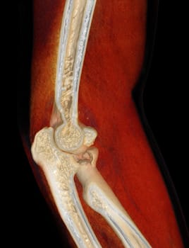 CT scan of elbow joint 3d rendering .