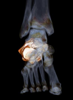 CT Scan ankle joint with  3d rendering of calcaneus bone showing Calcaneus (Heel Bone) Fractures.