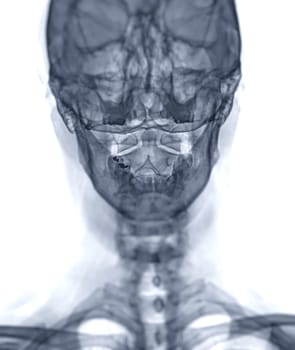 X-ray C-spine or x-ray image of Cervical spine open mount  view for  fracture of cervical vertebra 2nd ( axis ).