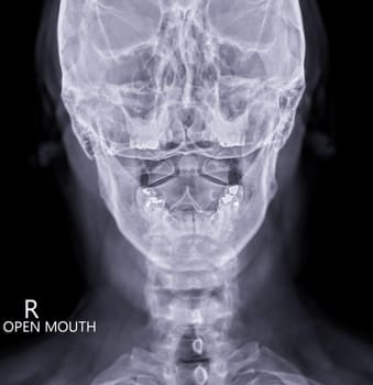 X-ray C-spine or x-ray image of Cervical spine open mount  view for  fracture of cervical vertebra 2nd ( axis ).