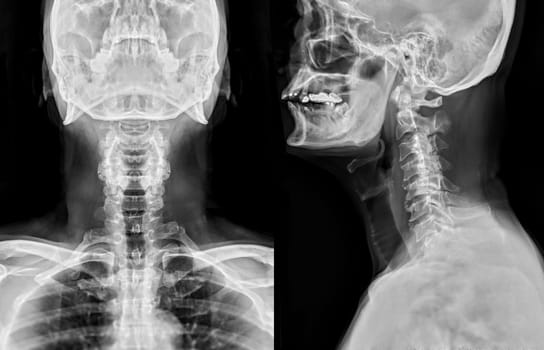 X-ray C-spine or x-ray image of Cervical spine AP and Lateral view for diagnostic intervertebral disc herniation ,Spondylosis and fracture.