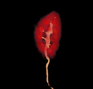 CTA Renal artery   showing kidney 3D rendering image.