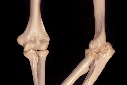 CT scan of elbow joint 3d rendering .