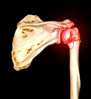 CT scan 3D rendering of Left shoulder showing fracture head of humerus .