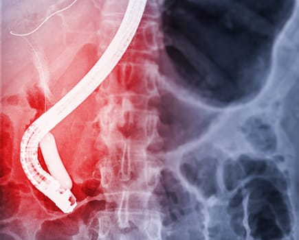 X-ray image of endoscopic after Doctor doing ERCP and laparoscopic cholecystectomy inside modern operating room.