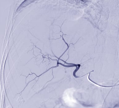 Imaging of TACE or Chemoembolization is a procedure that allows a dose of chemotherapy drugs to be administered directly to Liver tumor or HCC showing hepatic artery.