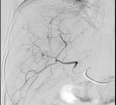 Imaging of TACE or Chemoembolization is a procedure that allows a dose of chemotherapy drugs to be administered directly to Liver tumor or HCC showing hepatic artery.