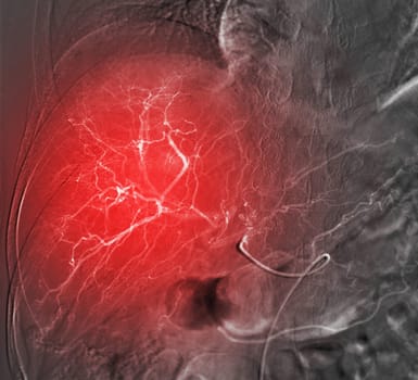 Imaging of TACE or Chemoembolization is a procedure that allows a dose of chemotherapy drugs to be administered directly to Liver tumor or HCC showing hepatic artery.