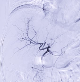 Imaging of TACE or Chemoembolization is a procedure that allows a dose of chemotherapy drugs to be administered directly to Liver tumor or HCC showing hepatic artery.