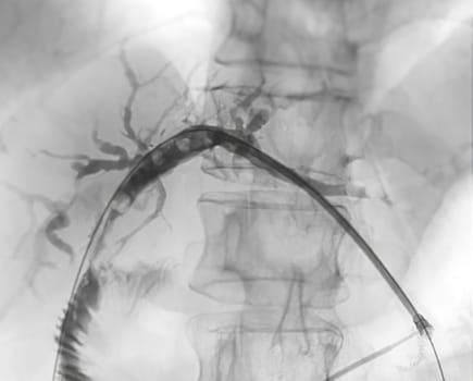 X-ray image of  portal vein  after Doctor doing ERCP and laparoscopic cholecystectomy inside modern operating room.