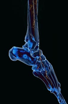 Femoral artery angiogram or angiography  at lower extremity area.